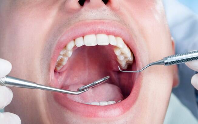 O siso sempre prejudica o alinhamento dos outros dentes? Nem sempre. Em alguns casos, ele tem espaço para nascer e não tem problema nenhum. Foto: iStock