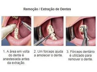 Etapas da extração dos dentes
