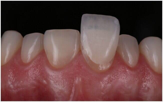 As lentes de contato dental so finas camadas de porcelana que encapam os dentes