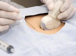 Amniocentese: até recentemente, exame era a única opção de teste de paternidade antes do nascimento