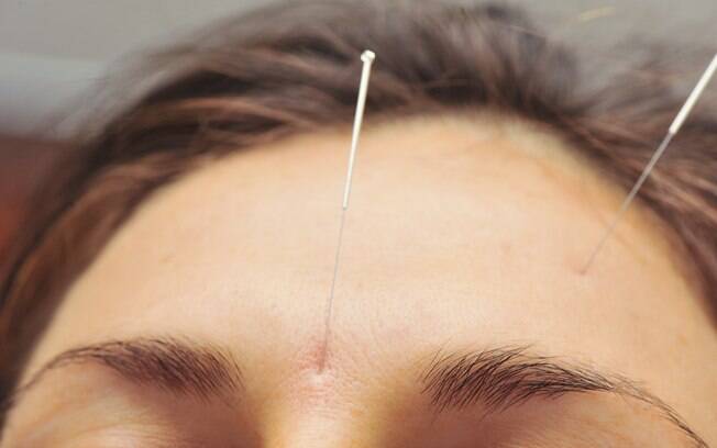 ACUPUNTURA: as agulhas ajudam a melhorar a dor. A acupuntura tem poder analgésico. Foto: Thinkstock