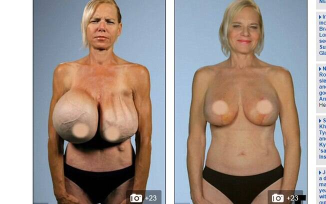 Antes e depois da cirurgia; apesar das cicatrizes, os seios de Dee puderam se reconstruídos. Foto: Reprodução/Daily Mail