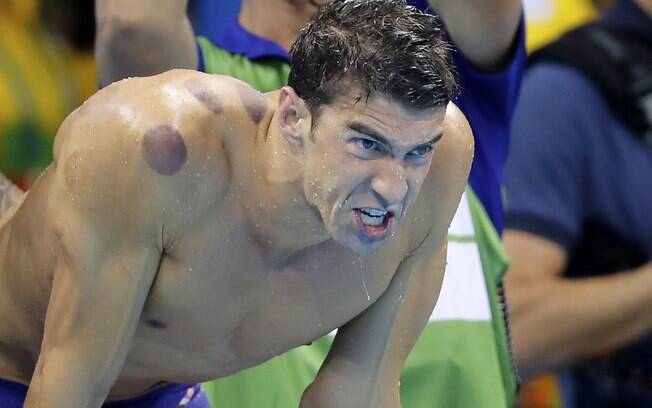 O nadador norte-americano Michael Phelps, vencedor de 19 medalhas de ouro, com marcas nos ombros e nas costas O nadador norte-americano Michael Phelps, vencedor de 19 medalhas de ouro, com marcas nos ombros e nas costas