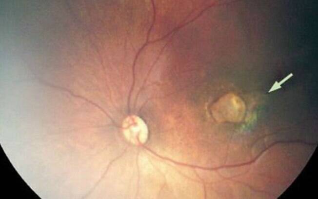 Foto mostra caso grave de atrofia de retina, que causa perda da visão, em bebê com microcefalia Foto mostra caso grave de atrofia de retina, que causa perda da visão, em bebê com microcefalia