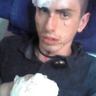 Cláudio Eising, de 22 anos, levou mais de quarenta pontos na mão e cinco na testa