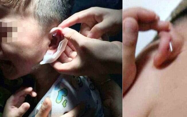 Os pais do menino só descobriram quando o filho começou a chorar durante o banho