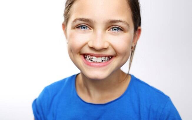 O alinhamento dos dentes é o objetivo mais comum para o uso dos aparelhos ortodônticos 
