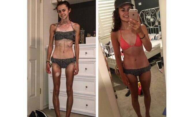 Claire de 20 anos, recorda em seu Instagram foto de quando sofria com anorexia Claire de 20 anos, recorda em seu Instagram foto de quando sofria com anorexia