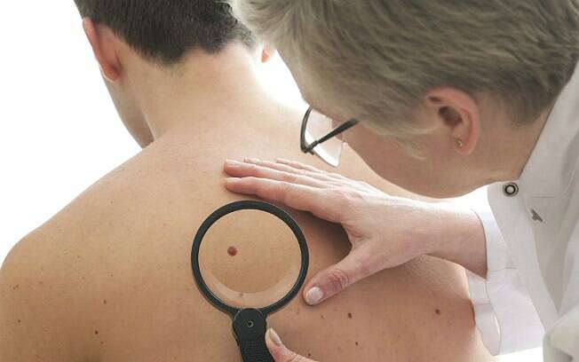 Câncer de pele não melanoma: 182 mil novos casos no Brasil em 2014/2015 (dados do Inca)