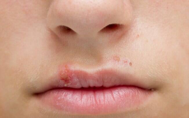Lesão típica do herpes: crise está relacionada com a baixa imunidade, tensão pré-menstrual, estresse e outros problemas Lesão típica do herpes: crise está relacionada com a baixa imunidade, tensão pré-menstrual, estresse e outros problemas