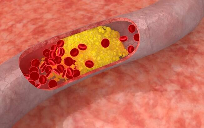 Placa de colesterol dentro de uma artéria; homens com hipercolesterolemia familiar sem tratamento podem infartar antes dos 40 anos