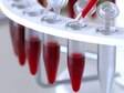 Exame de sangue detecta até 86% de casos de câncer de ovário precocemente