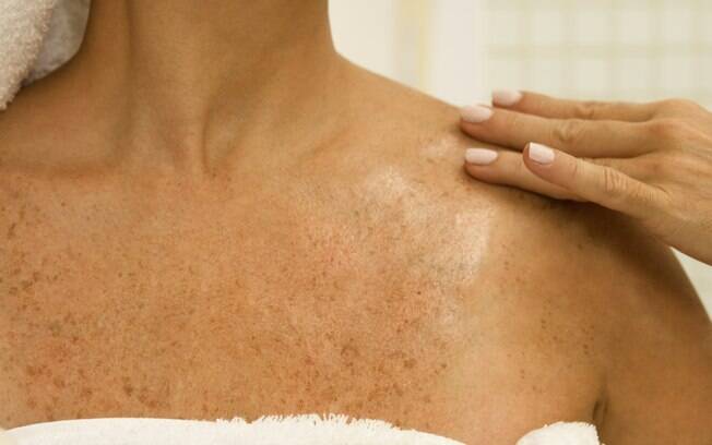 Autoexaminar periodicamente as pintas e manchas da pele e consultar um médico em caso de anormalidade é fundamental para evitar o câncer de pele