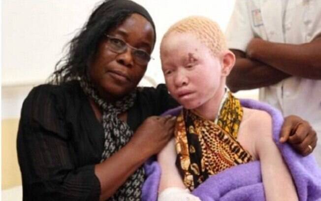 A adolescente Pendo Sengerema ao lado da avó em hospital da Tanzânia. Ela teve o braço decepado quando saía de casa (arquivo). Foto: Tanzania Albinism Society