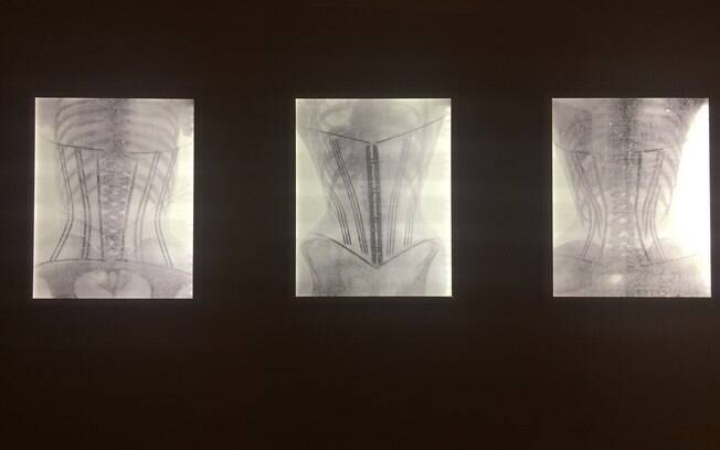 Radiografias do início do século 20 mostram como o uso de corpetes alterava a posição das costelas, preocupando os médicos