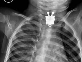 27.01.2015 - Radiografia revela Bob Esponja no esofago de garoto de 1 ano . Menino engoliu pingente da irma que tinha o formato do personagem . O objeto foi retirado sem complicacoes e garoto passa bem .

FOTO : Cortesia - Ghofran Ageely / Radiopaedia.org