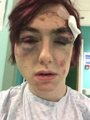 Robbie Kingsford, de 18 anos, foi agredido junto de seu amigo por dois homens vestidos de fada em Londres, no último sábado (01)