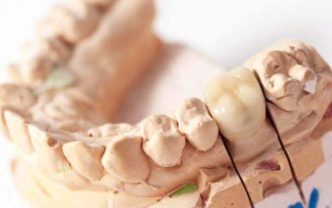 Erosão nos dentes. Foto: Thinkstock/Getty Images