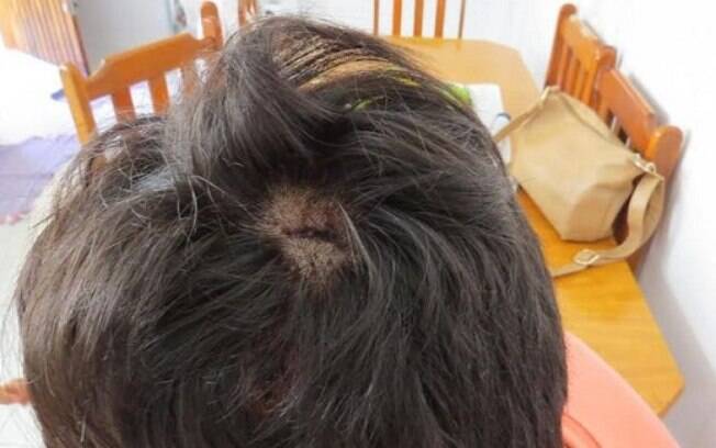 Corte na cabeça foi resultado de agressão a golpes de skate de que garoto homossexual foi vítima em São Paulo