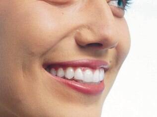 Modelo usa aparelho Invisalign