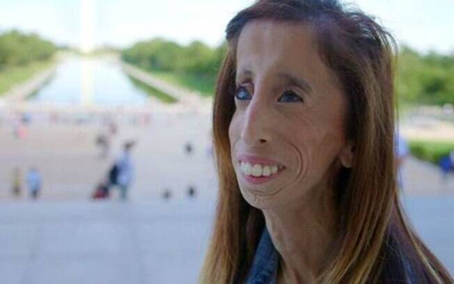 Lizzie Velasquez sofre de deficiência visual e tem síndrome que a impede de ganhar peso