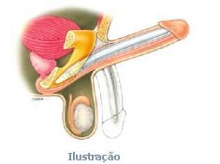 Prótese de silicone maleável, usada nas cirurgias feitas em homens com disfunção erétil