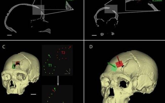 Ferimentos no crânio de um ancestral encontrado na Espanha mostram que ele foi morto por outro hominídeo