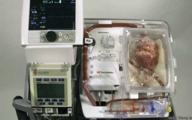 A máquina batizada de 'coração em caixa' permitiu aos médicos manter o coração de paciente morto próprio para transplante . Foto: Divulgação