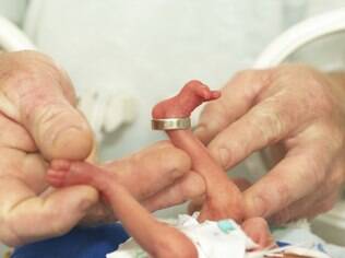 Prematuro em incubadora: embora índice de sobrevivência seja alto, sequelas podem ser graves