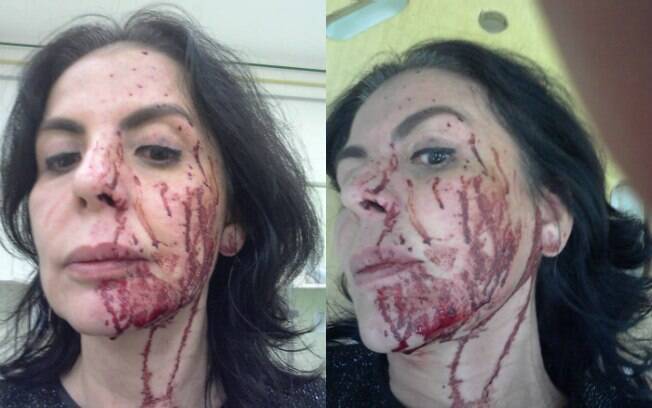 Andréa Guimarães, mulher do ator Castrinho, mostrou rosto machucado após assalto