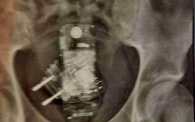 Celular e carregador foram encontrados no reto do detento Leonardo Antônio de Araujo