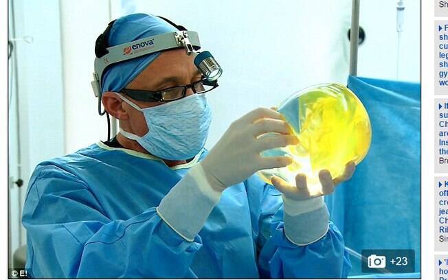 Cirurgião disse que havia uma colônia de fungos crescendo dentro do implante de silicone. Foto: Reprodução/Daily Mail