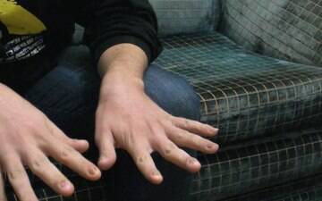 Refugiado no Brasil teve unhas arrancadas em tortura na Síria