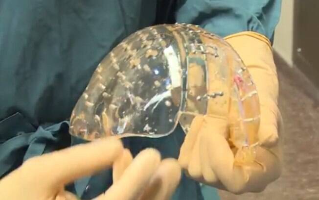 Prótese de crânio desenvolvida em impressora 3D foi implantada em paciente na Holanda. Foto: Divulgação