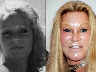 Donatella Versace  Botox, Cirurgia plastica, Cirurgias