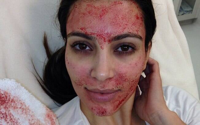 Kim Kardashian publicou a foto de seu rosto banhado em sangue após o