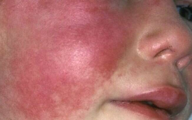 Sintomas da doença incluem textura áspera da pele e vermelhidão, além de dor de garganta