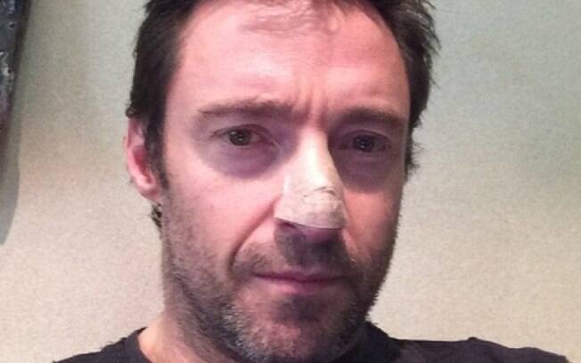 Hugh Jackman trata câncer de pele