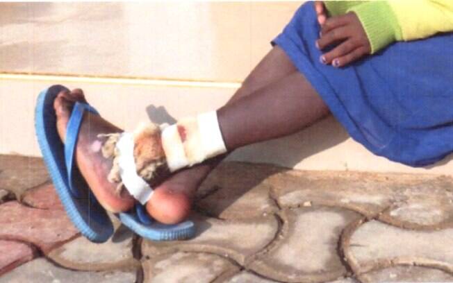 Boche, de 10 anos, teve pedaço do tornozelo arrancado pelo pai na Tanzânia por se recusar a se submeter à mutilação genital