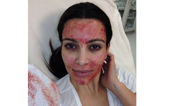 Kim Kardashian mostra no Twitter foto em que aparece com o rosto ensanguentado durante tratamento estético 