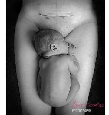 Foto mostra cicatriz do parto, causa polêmica e gera desabafos
