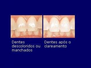 Se as manchas estiverem presentes há anos, você pode necessitar de clareamento