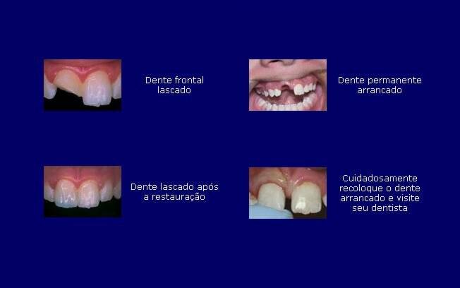 Exemplos de dentes fraturados