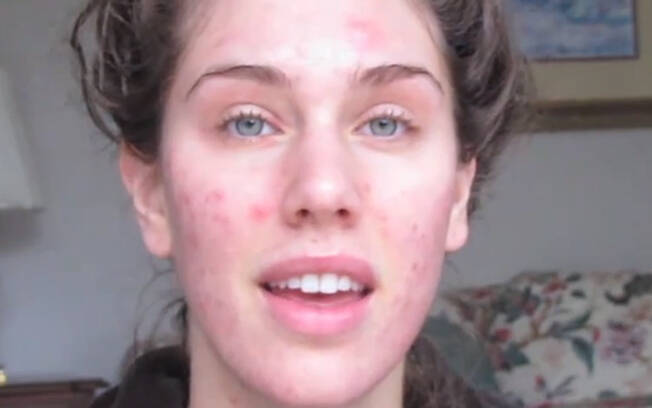 Atriz ensina tutorial perfeito para disfarçar acne com ajuda de
