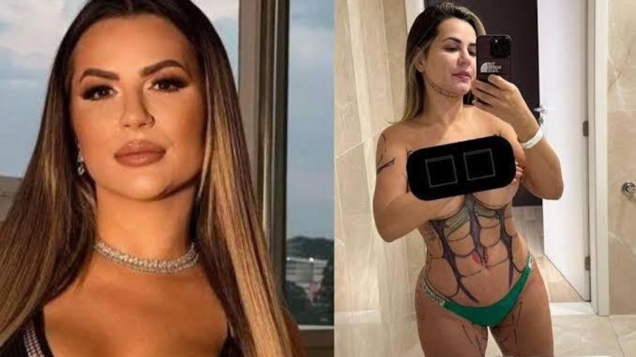 Deolane Bezerra exibe marcações da lipoaspiração que realizou recentemente