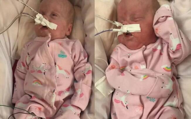 Irmãs gêmeas são prematuras e nascem 18 semanas antes do previsto pelos médicos