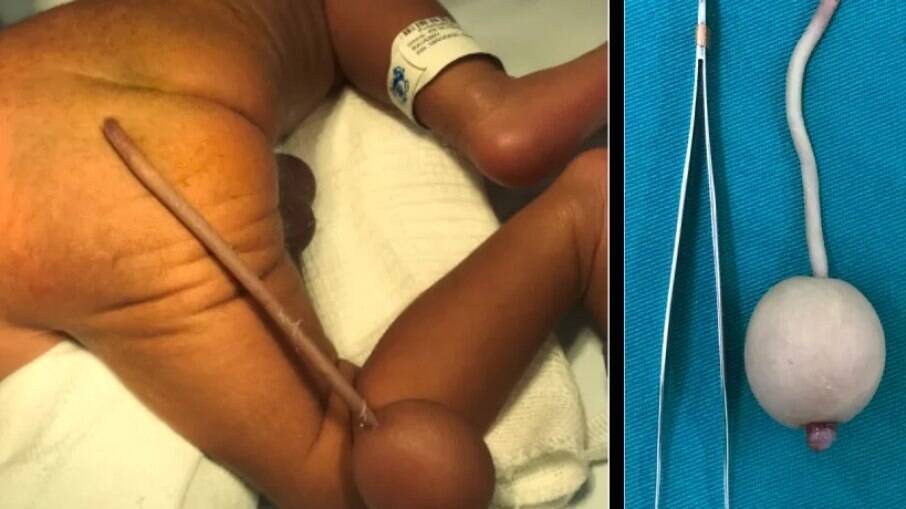 Bebê brasileiro nasce com 'cauda' de 12 cm