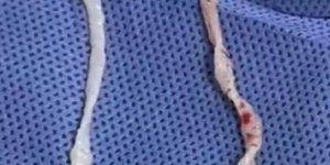Médicos retiram vermes vivos do braço de mulher após um ano