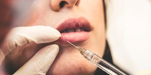 Preenchimento labial natural ganha espaço na harmonização
