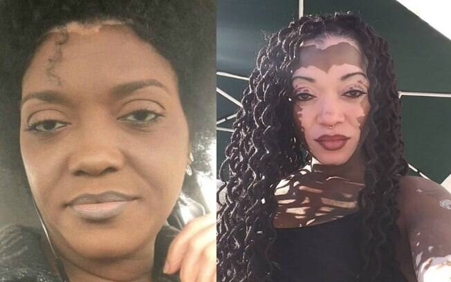 Denise Chamberlain usou maquiagem por 30 anos para cobrir as manchas de vitiligo no rosto por ter vergonha da aparência